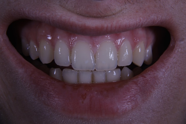 4 Beneficios de usar una guarda miorrelajante para dientes