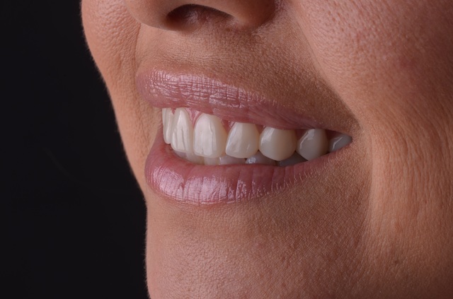 4 Beneficios de la Radiografía Panorámica Dental en el Diagnóstico