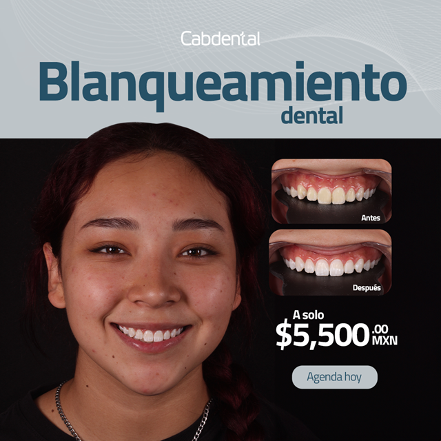 Carillas dentales o blanqueamiento Carillas dentales o blanqueamiento