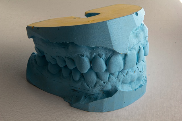 Brackets estéticos: La opción discreta para una sonrisa perfecta Brackets estéticos: La opción discreta para una sonrisa perfecta
