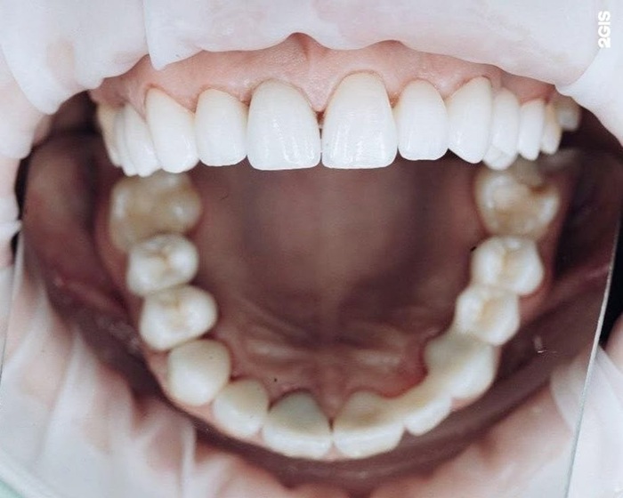 Beneficios clave de las coronas de cerómero