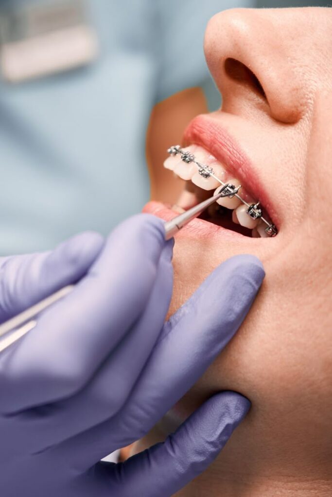 Beneficios de los brackets autoligados en el día a día Beneficios de los brackets autoligados en el día a día