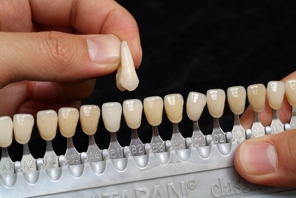 Cerómeros Dentales en México: Aplicaciones y Beneficios
