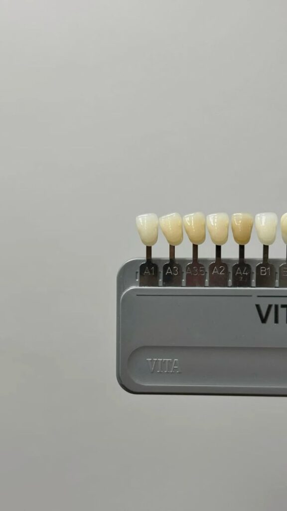 Ventajas Competitivas de los Cerómeros en Odontología Mexicana