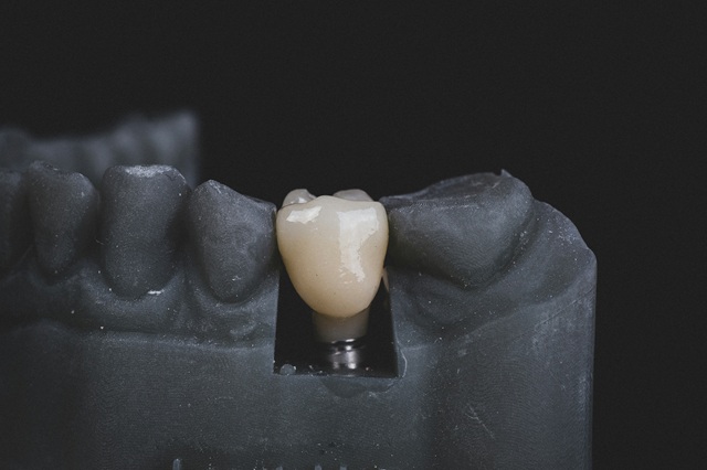 Ortoimplantes Dentales: Ventajas, Procedimiento y Cuidados