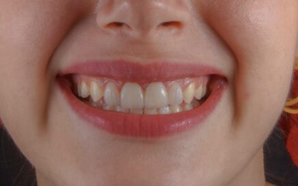Ortoimplantes Dentales: Ventajas, Procedimiento y Cuidados