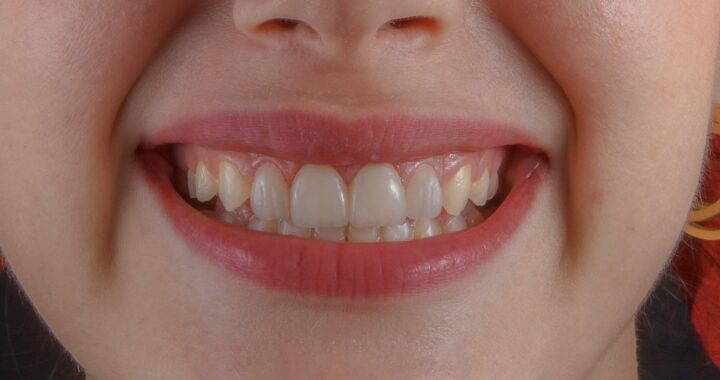 Ortoimplantes Dentales: Ventajas, Procedimiento y Cuidados