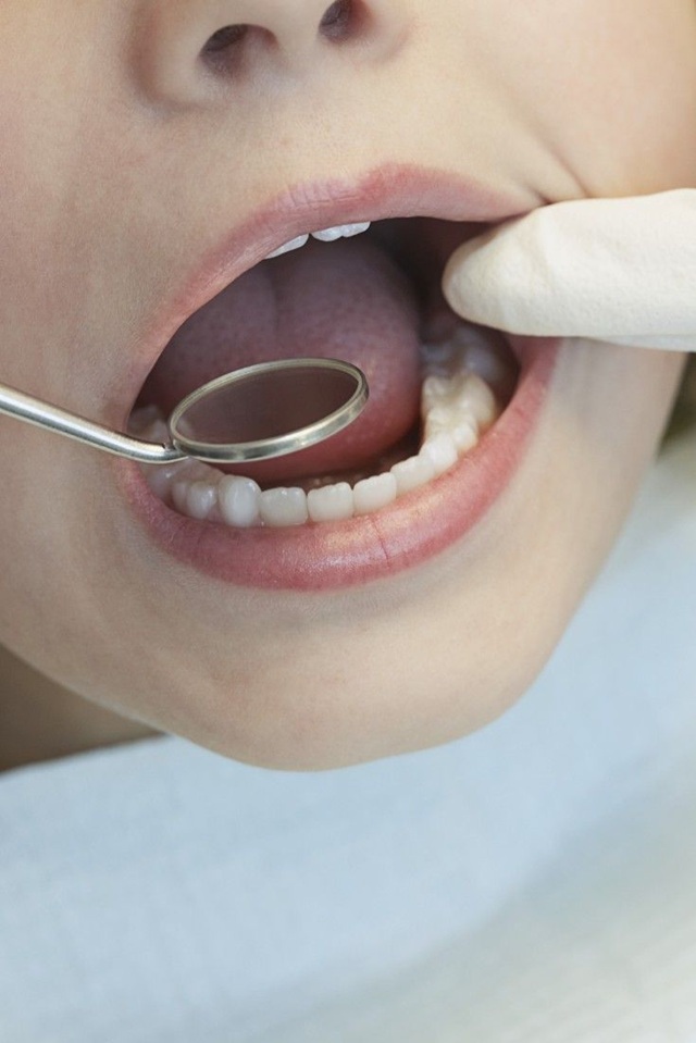Mantenedores de Espacio Dentales para Niños: Guía Completa para Padres