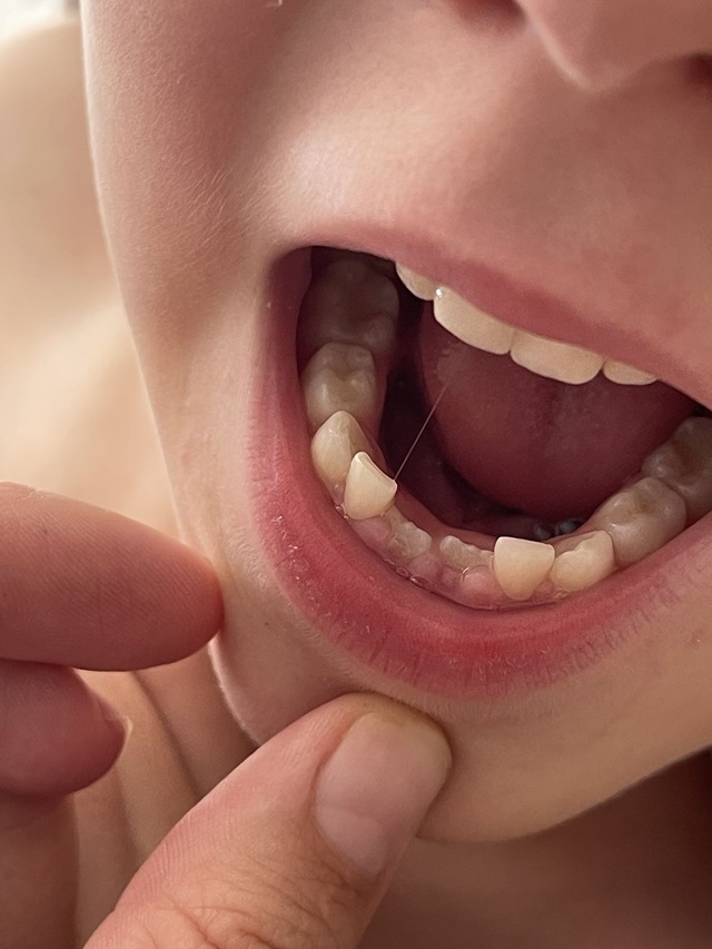 Mantenedores de Espacio Dentales para Niños: Guía Completa para Padres