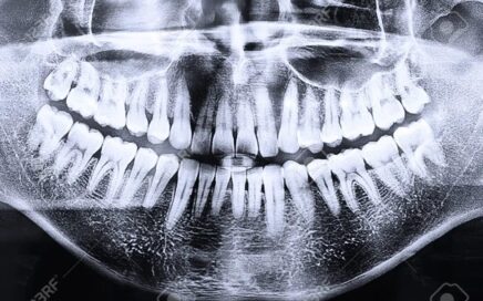 Radiografía Panorámica Dental: Para Qué Sirve y Qué Esperar del Estudio