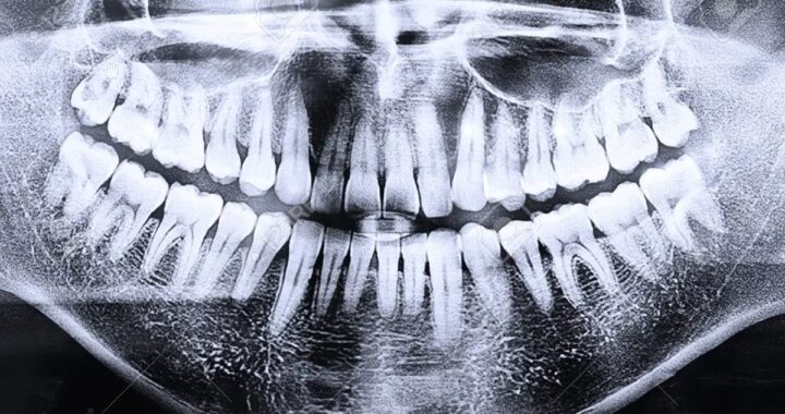 Radiografía Panorámica Dental: Para Qué Sirve y Qué Esperar del Estudio