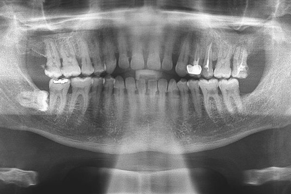 Radiografía panorámica con una muela del juicio retenida